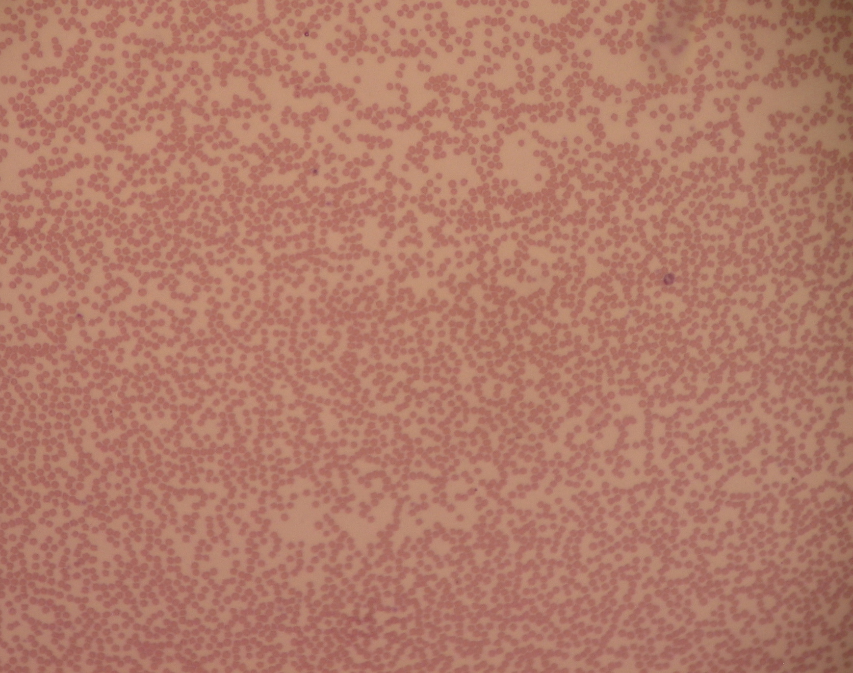 Imagem de referência de neutropenia, descrito nos dados abertos como concentração anormalmente baixa de neutrófilos no sangue