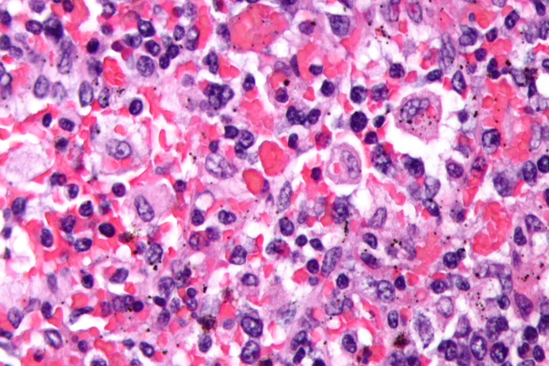 Imagem de referência de linfo-histiocitose hemofagocítica, descrito nos dados abertos como condição médica