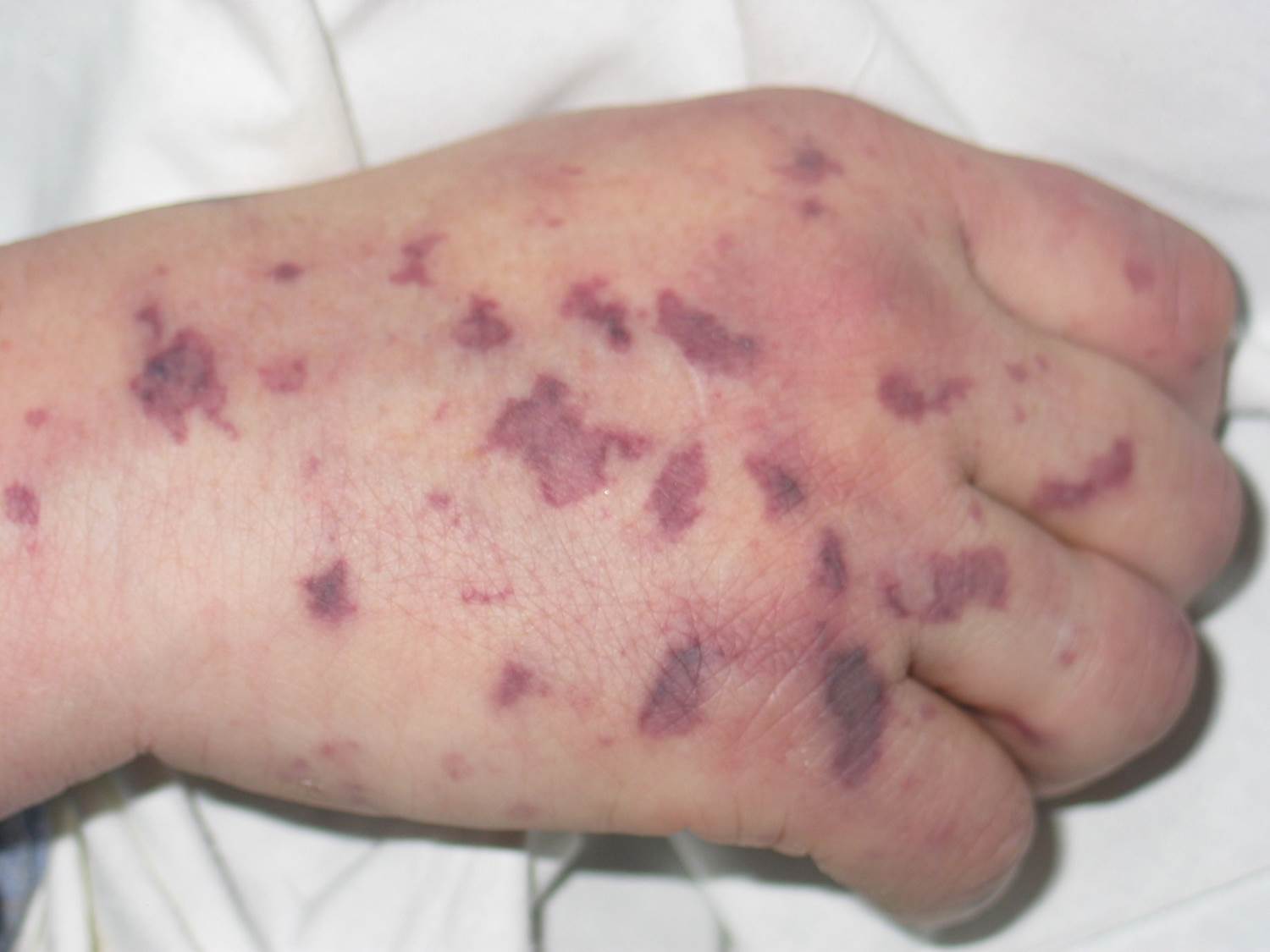 Imagem de referência de meningococcemia, descrito nos dados abertos como infecção que afeta as meninges