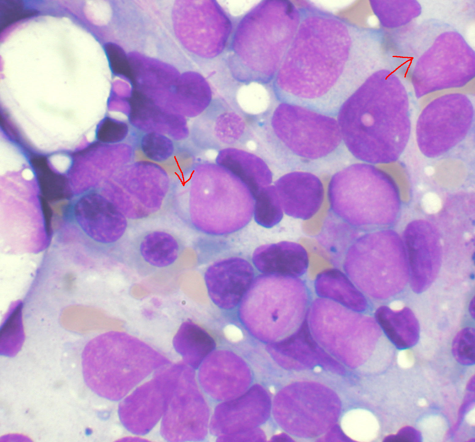 Imagem de referência de leucemia mieloide aguda, descrito nos dados abertos como câncer que Afeta as Células Brancas do Sangue